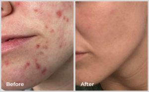 Before and after Spectrum’s IPL and Erbium laser treatments